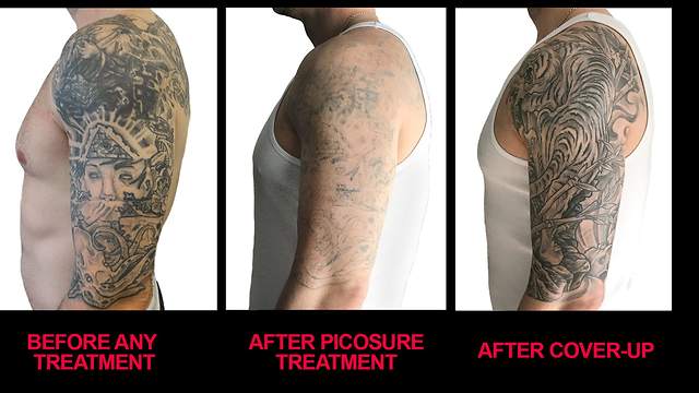 Best Laser Tattoo Removal in Wichita, KS - Evicted Ink