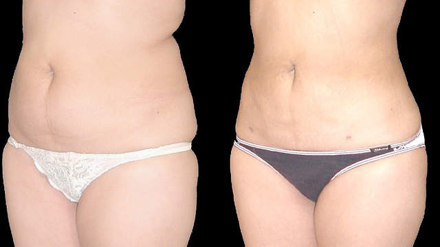 Cool Sculpting Tips: Before and After You Receive The Treatment