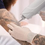 Beyond the Surface: Embracing Microdermabrasion, Laser Tattoo Removal, and Clinic Expertise for Skin Renewal